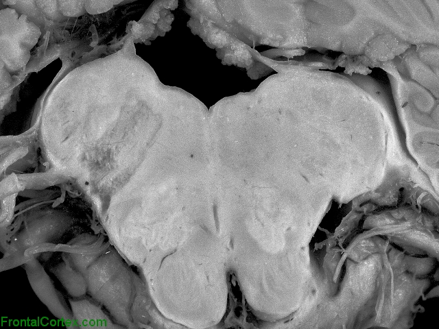 Dorsolateral Medullary Infarct, transverse section.